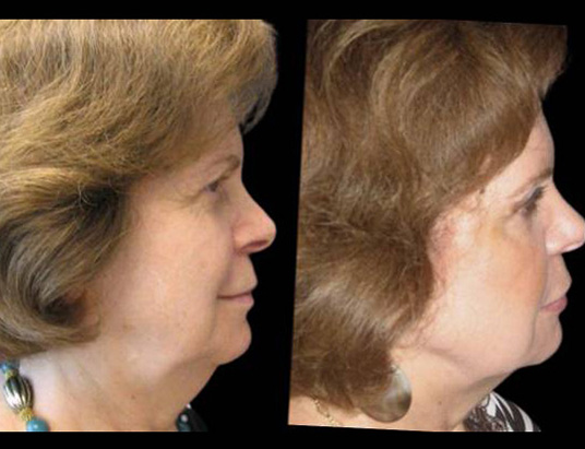 female-non-surgical-facelift-before-and-after-side-view.jpg