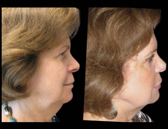 female-non-surgical-facelift-before-and-after-side-view.jpg