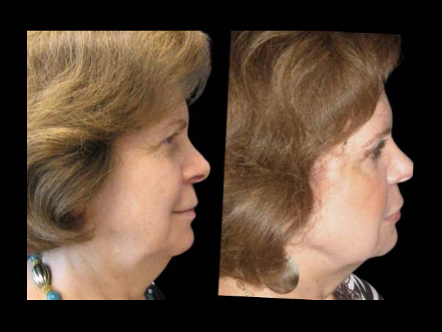 female-non-surgical-facelift-before-and-after-side-view.jpg