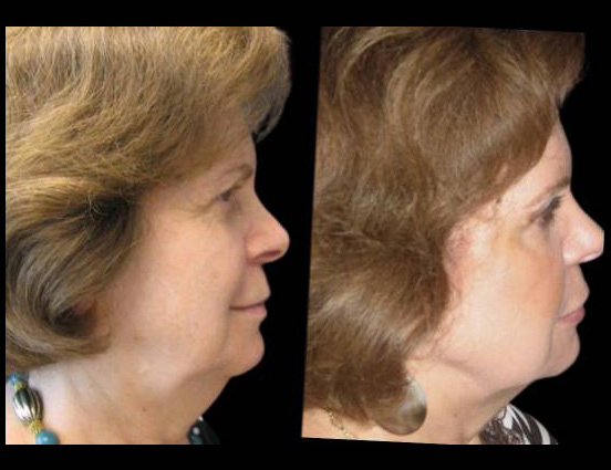 female-non-surgical-facelift-before-and-after-side-view.jpg.jpg