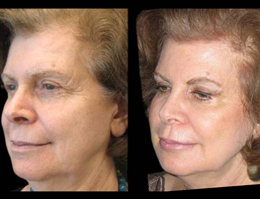 female-non-surgical-facelift-before-and-after-three-quarter-view.jpg
