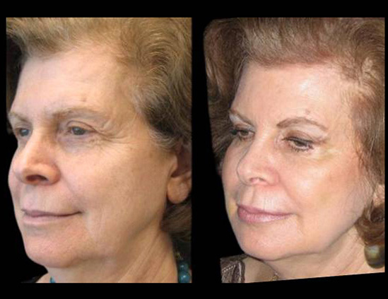 female-non-surgical-facelift-before-and-after-three-quarter-view.jpg
