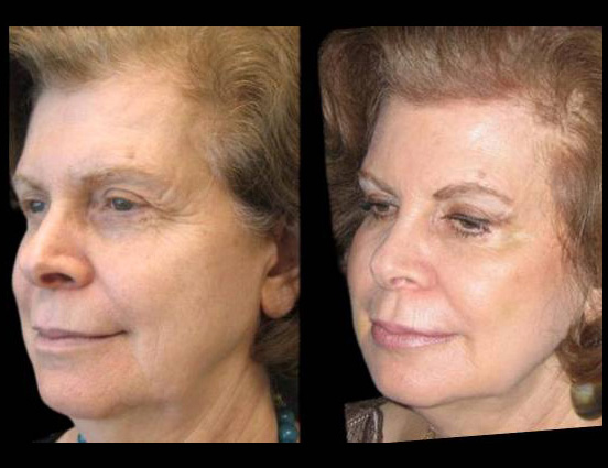 female-non-surgical-facelift-before-and-after-three-quarter-view.jpg.jpg