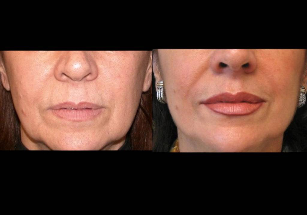 female-restylane-before-and-after-front-view-2.jpg