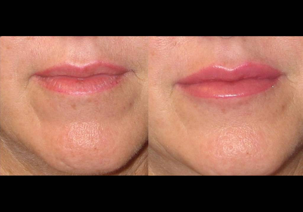 female-restylane-before-and-after-front-view-3.jpg
