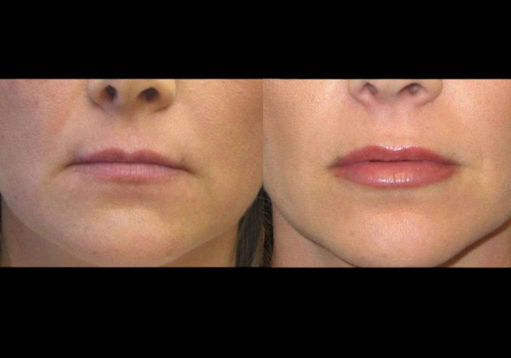 female-restylane-before-and-after-front-view-4.jpg