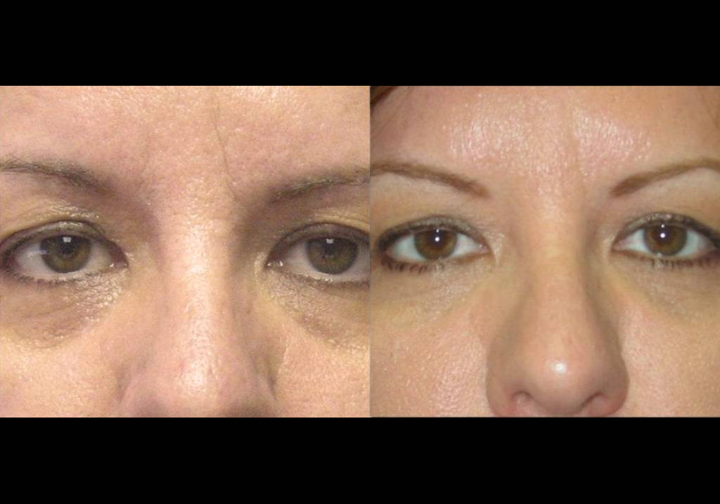 female-restylane-before-and-after-front-view.jpg