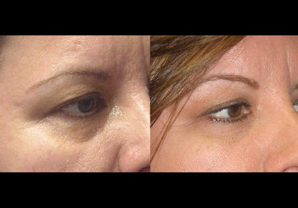 female-restylane-lift-before-and-after-three-quarter-view.jpg