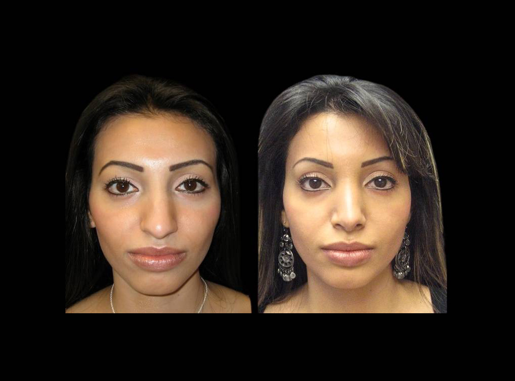 female-rhinoplasty-front-view-1.jpg
