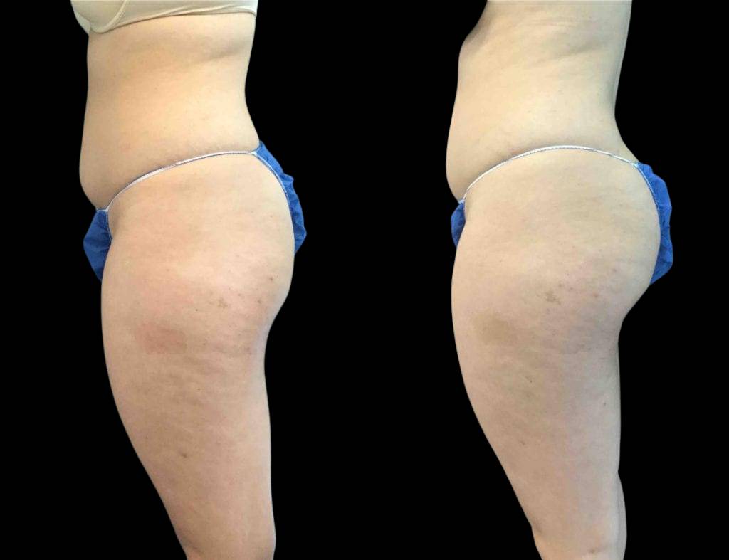 female-sculptra-butt-lift-before-and-after