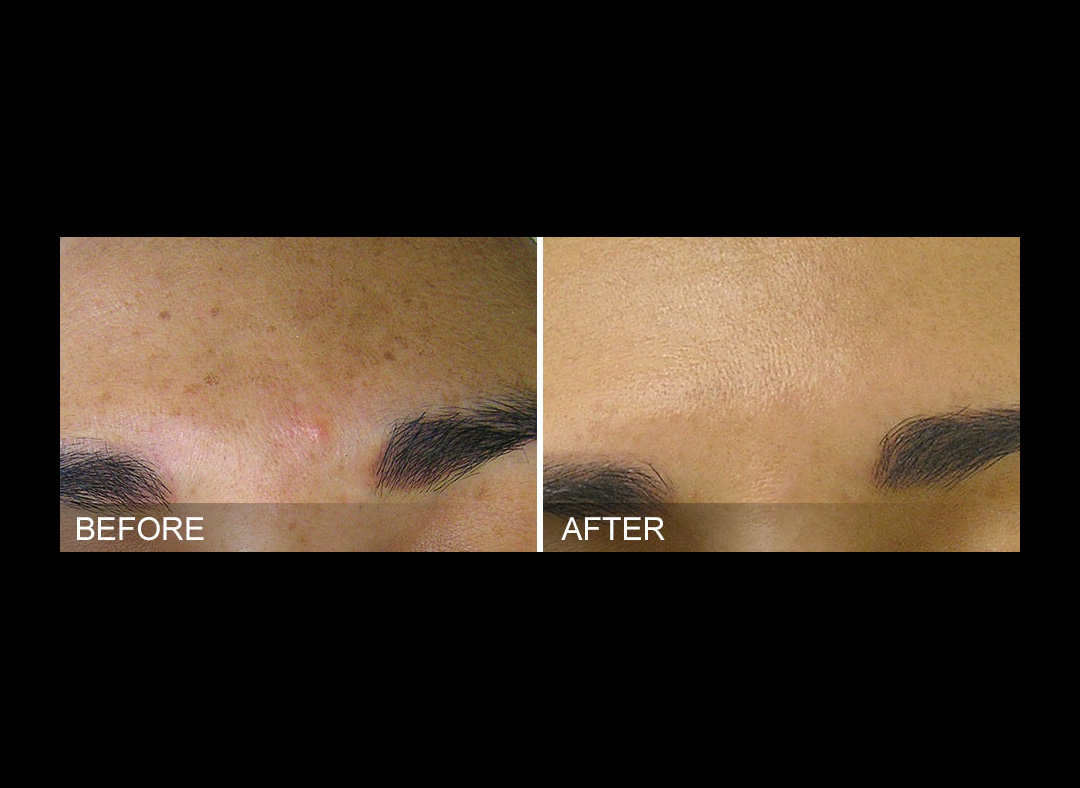 hydrafacial-before-and-after-bitar-cosmetic-industry.jpg