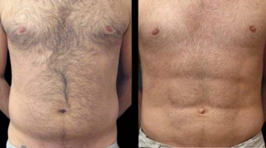 This is a male that has had an abdominal etching done showing the before and after's side-by-side