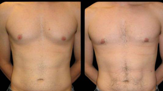 This is a male that has had an abdominal etching done showing the before and after's side-by-side