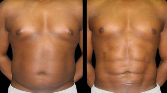 This is a male that has had an abdominal etching done showing the before and after's side-by-side