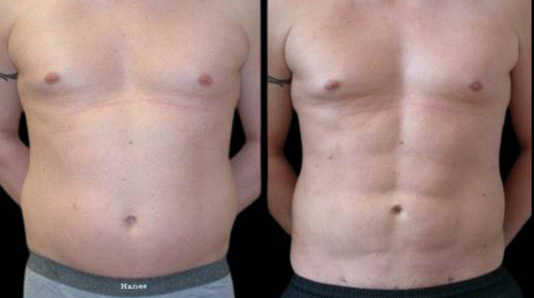 This is a male that has had an abdominal etching done showing the before and after's side-by-side