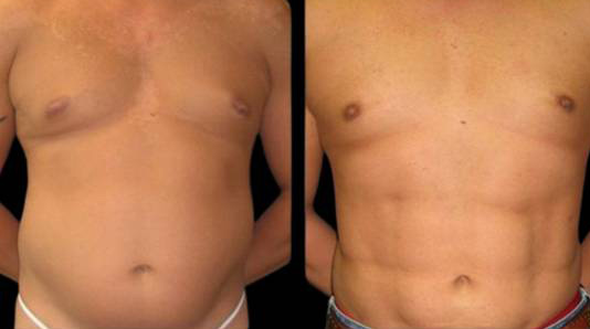 This is a male that has had an abdominal etching done showing the before and after's side-by-side