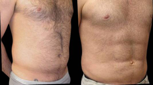 This is a male that has had an abdominal etching done showing the before and after's side-by-side