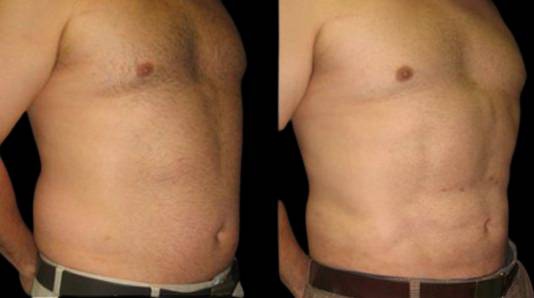 This is a male that has had an abdominal etching done showing the before and after's side-by-side