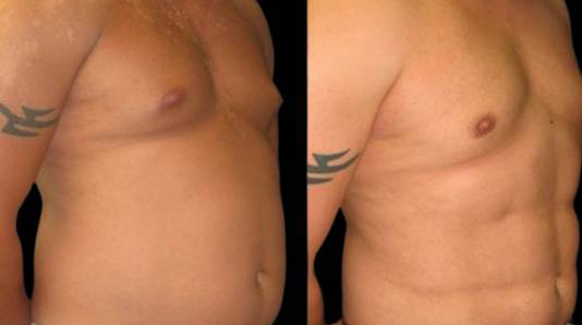 This is a male that has had an abdominal etching done showing the before and after's side-by-side