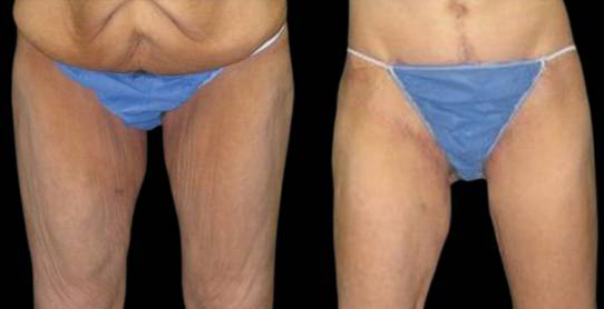male-inner-thigh-lift-before-and-after-front-view-1.jpg