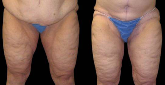 male-inner-thigh-lift-before-and-after-front-view.jpg