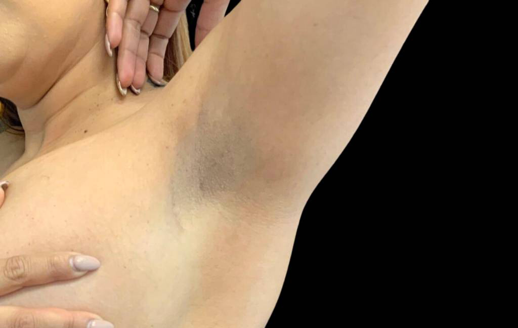 This is a 36-year-old female transaxillary scar showing the before and after's side-by-side