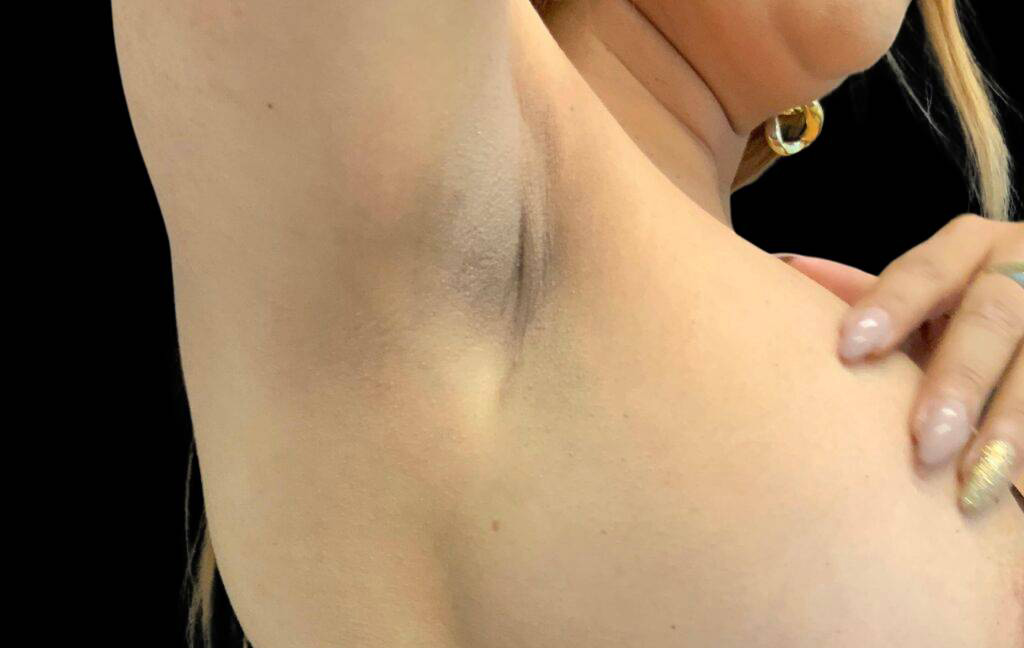 This is a 36-year-old female transaxillary scar showing the before and after's side-by-side