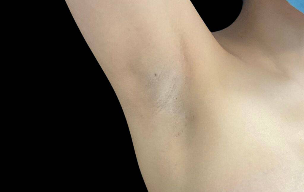 This is a 25-year-old female that has had a transaxillary scar showing the before and after's side-by-side