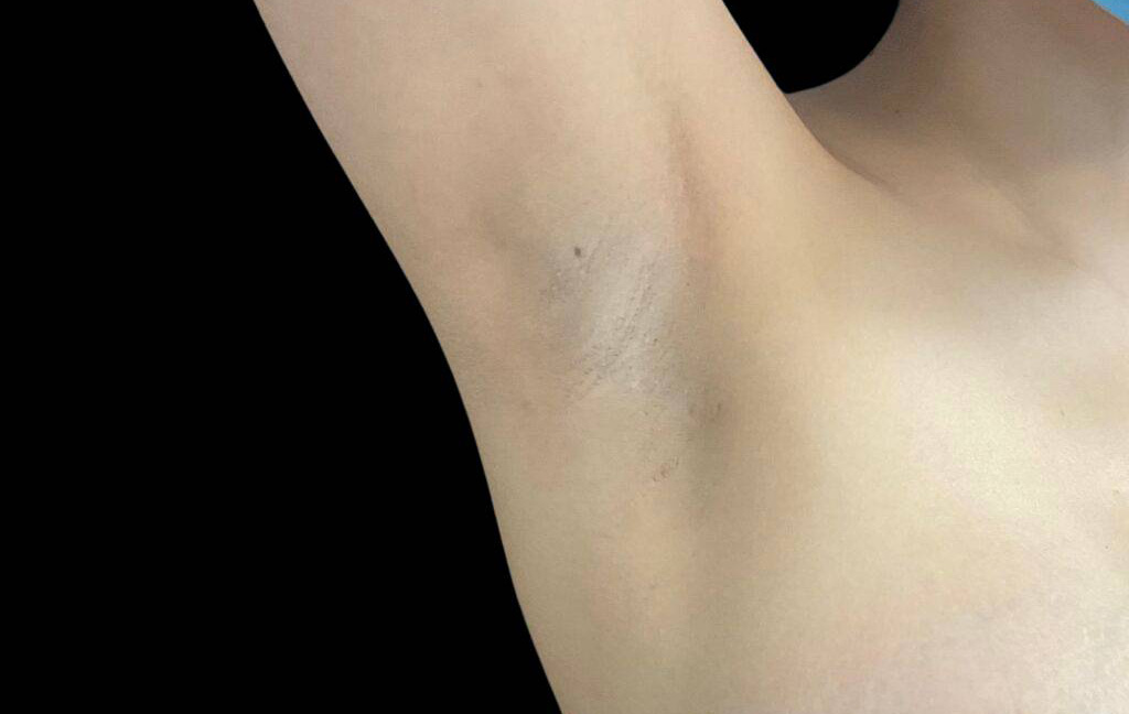 This is a 25-year-old female transaxillary scar showing the before and after's side-by-side