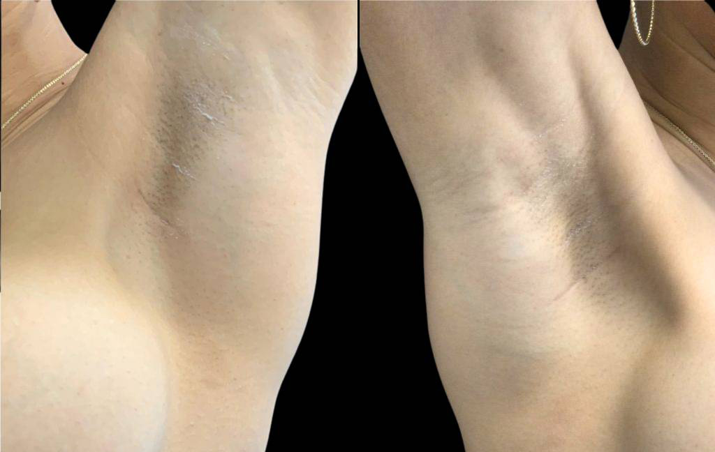 This is a 32-year-old female transaxillary scar showing the before and after's side-by-side