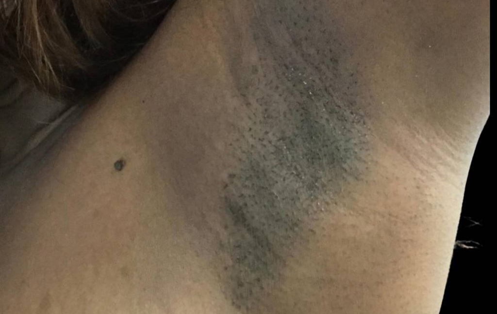 This is a 36-year-old female transaxillary scar showing the before and after's side-by-side