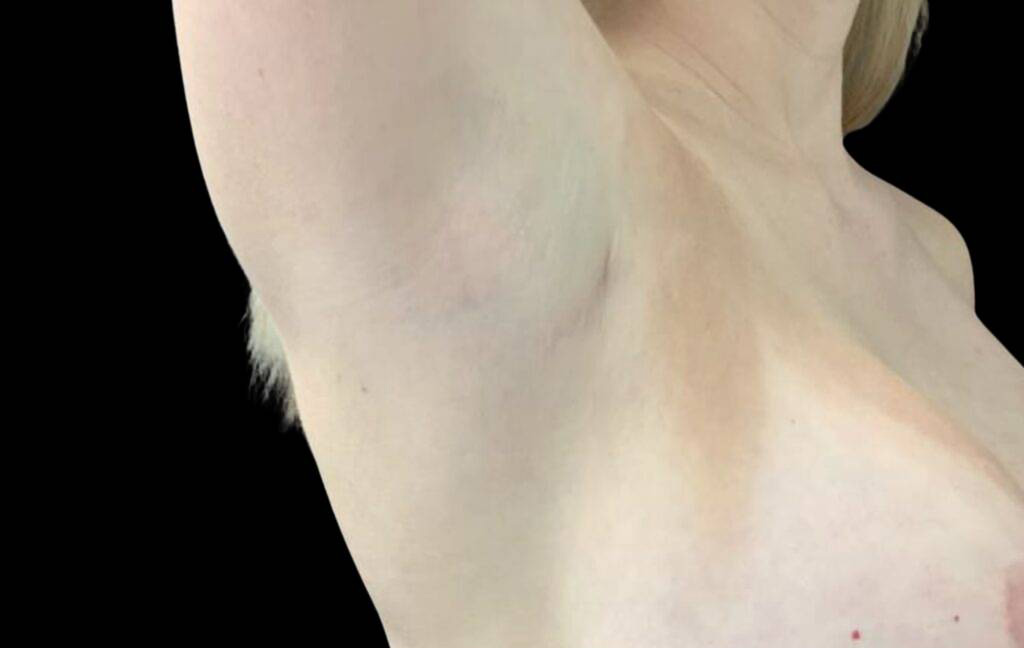 This is a 40-year-old female that has had a transaxillary scar showing the before and after's side-by-side