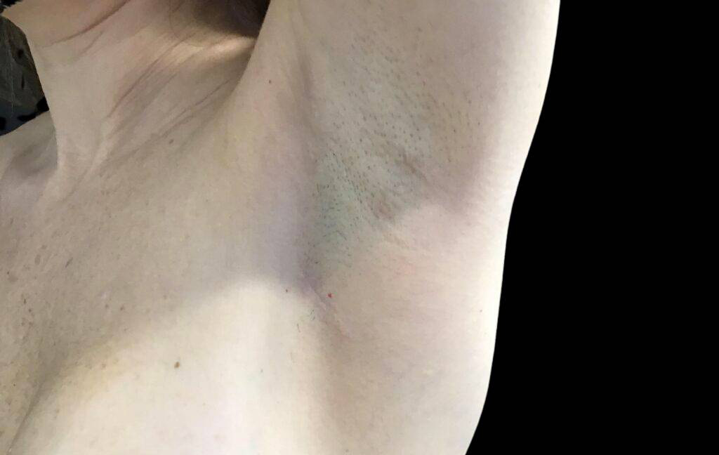 This is a 42-year-old female that has had a transaxillary scar showing the before and after's side-by-side