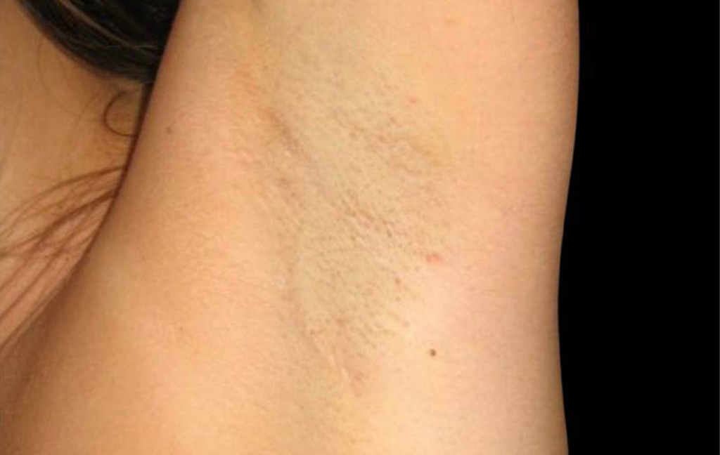 This is a female that has had a transaxillary scar showing the before and after's side-by-side