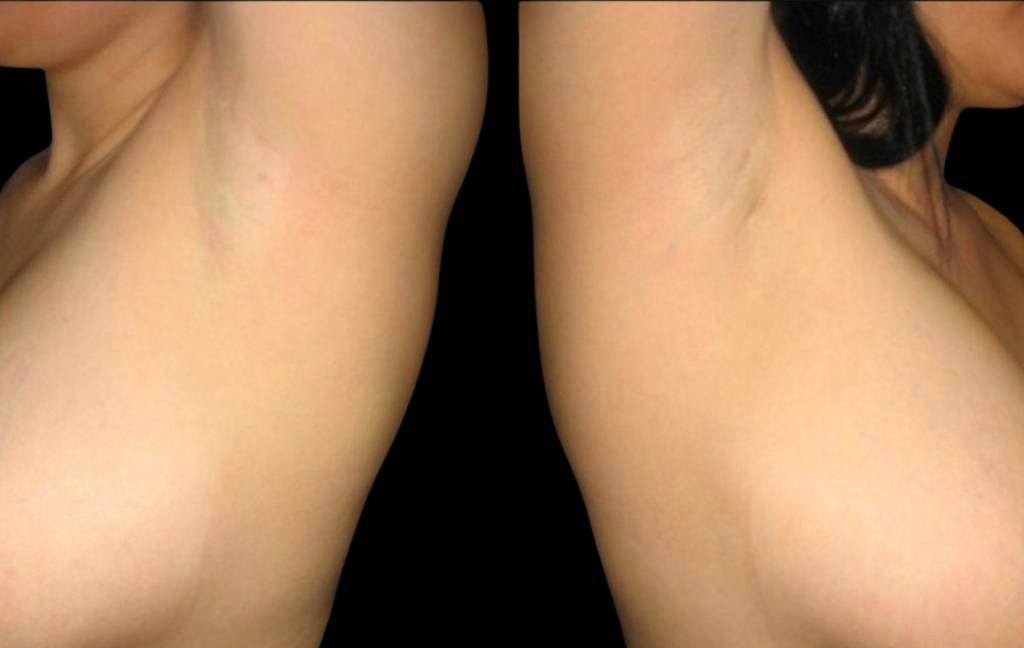 This is a female that has had a transaxillary scar showing the before and after's side-by-side