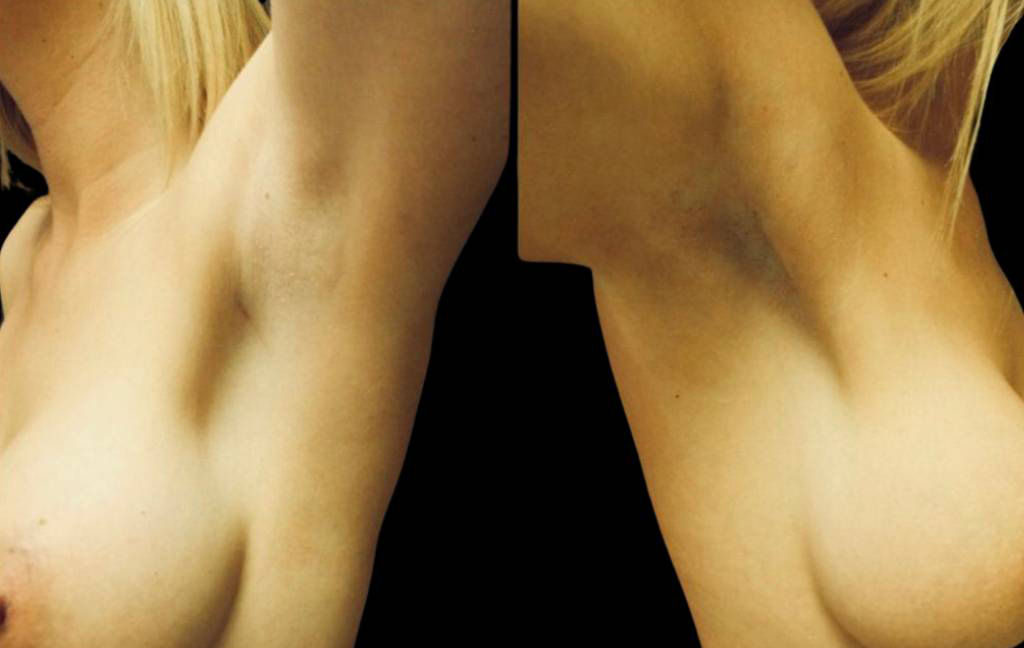 This is a female that has had a transaxillary scar showing the before and after's side-by-side