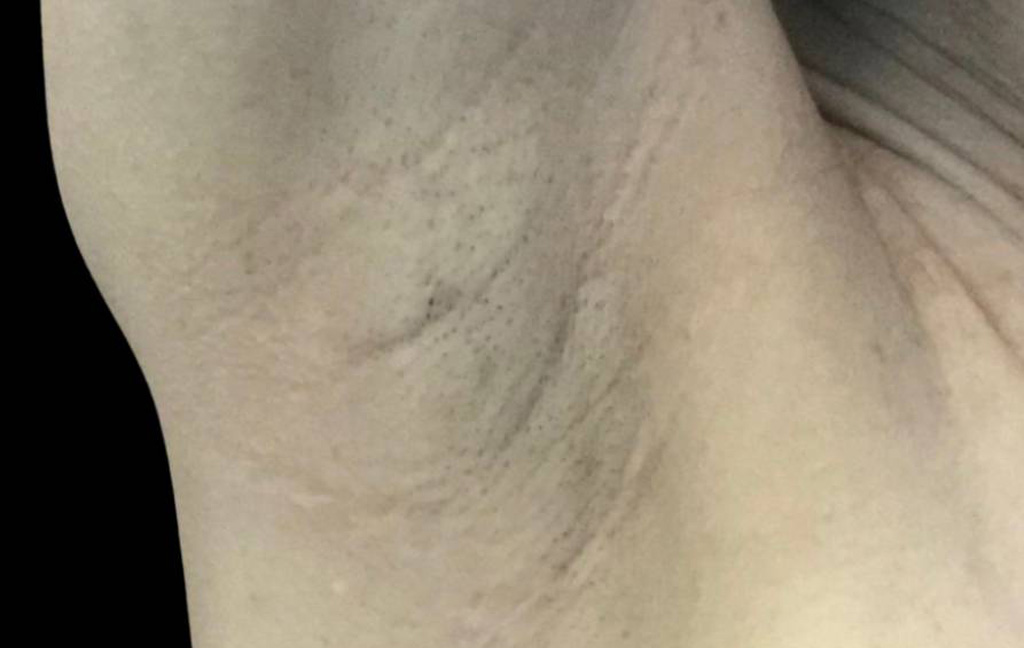 This is a female that has had a transaxillary scar showing the before and after's side-by-side