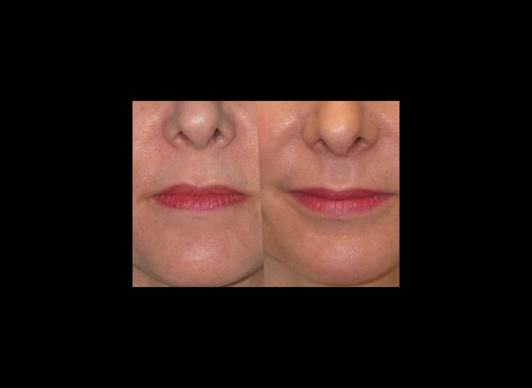 restylne-lift-before-and-after-1.jpg