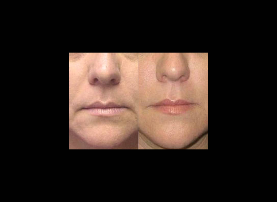 restylne-lift-before-and-after.jpg