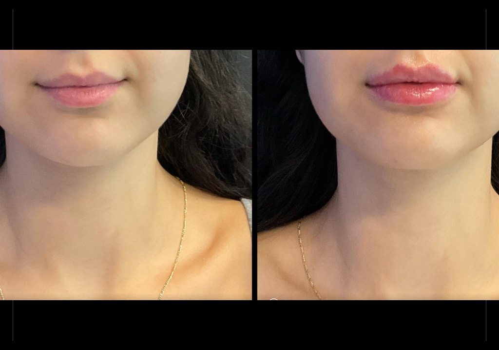 thumbnail_Copy-of-Lip-filler_female-1.jpg