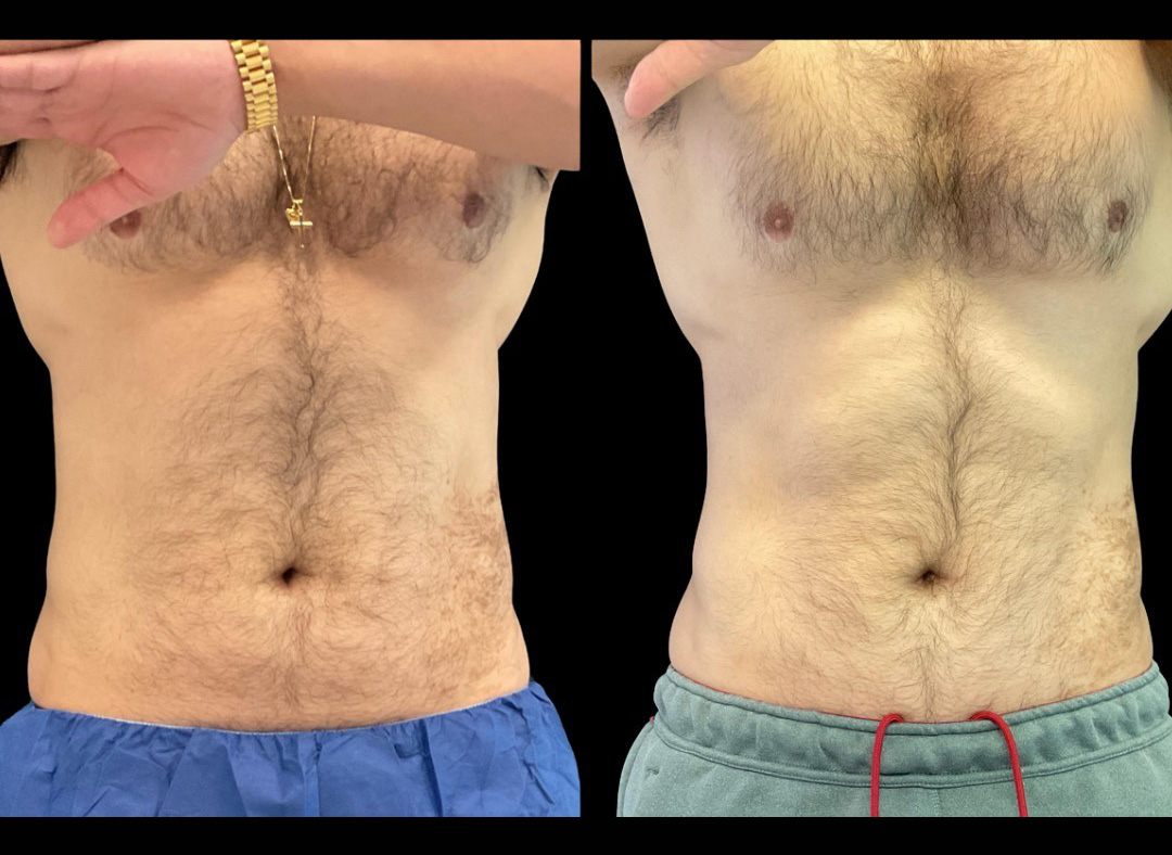 thumbnail_Emsculpt_Male_Before_and_After-1.jpg