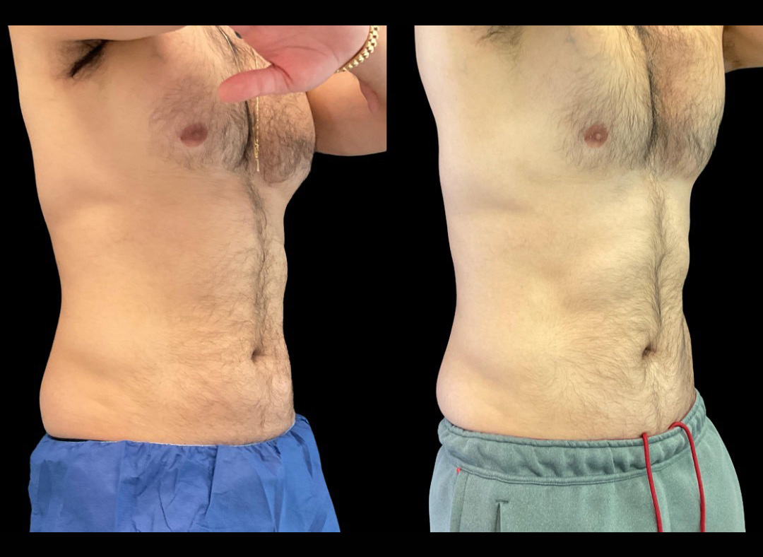 thumbnail_Emsculpt_Male_Before_and_After-2.jpg