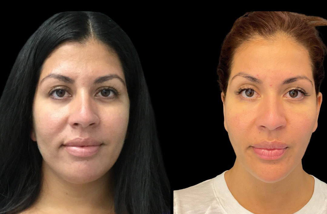 thumbnail_Fillerskincare_female_beforeafter-1.jpg
