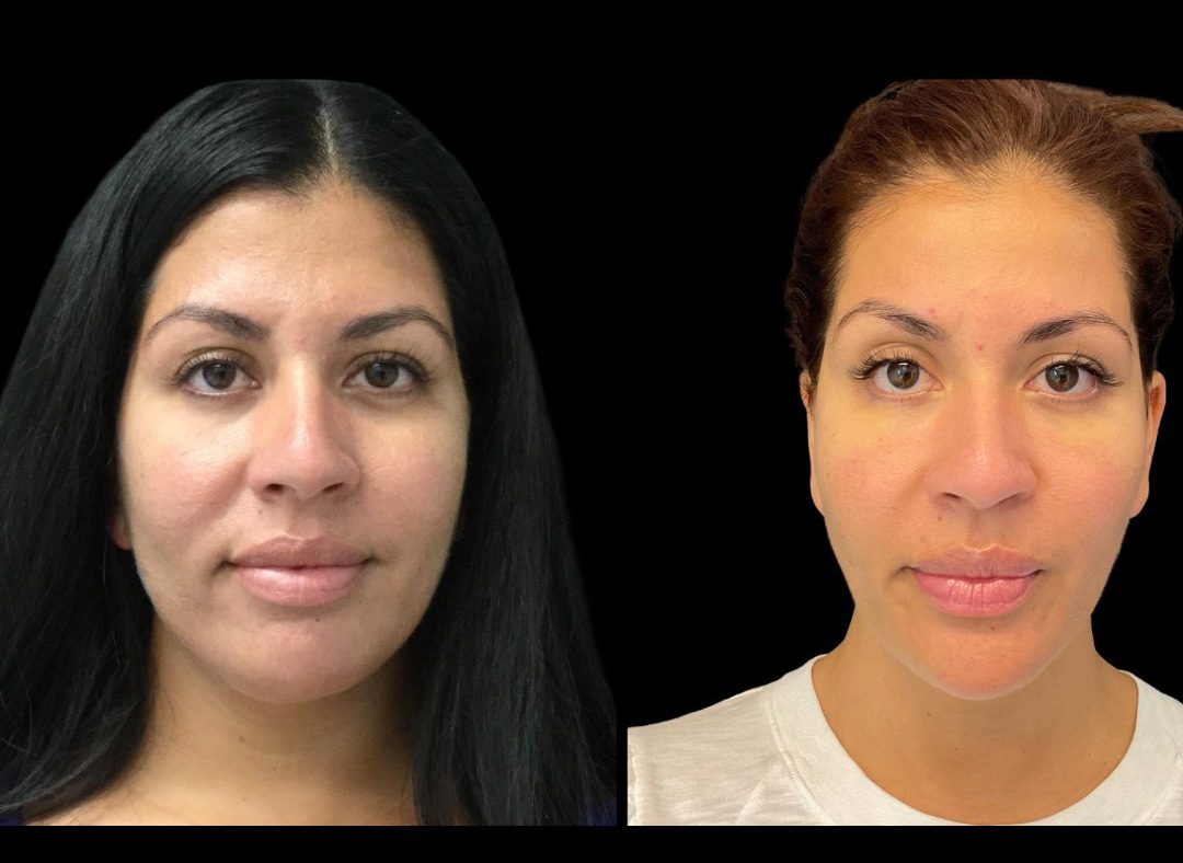 thumbnail_Fillerskincare_female_beforeafter-1.jpg