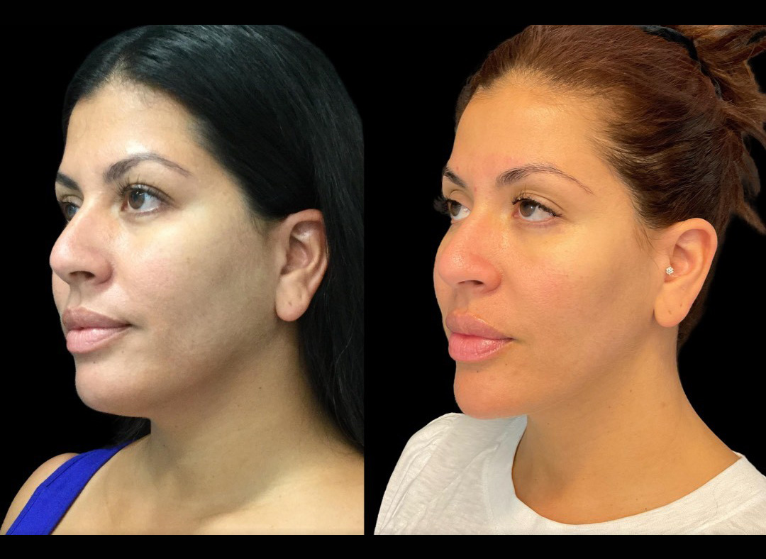 thumbnail_Fillerskincare_female_beforeafter-2.jpg