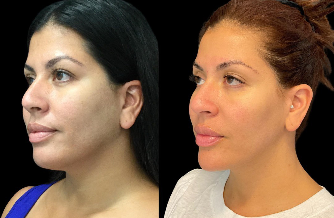 thumbnail_Fillerskincare_female_beforeafter-2.jpg