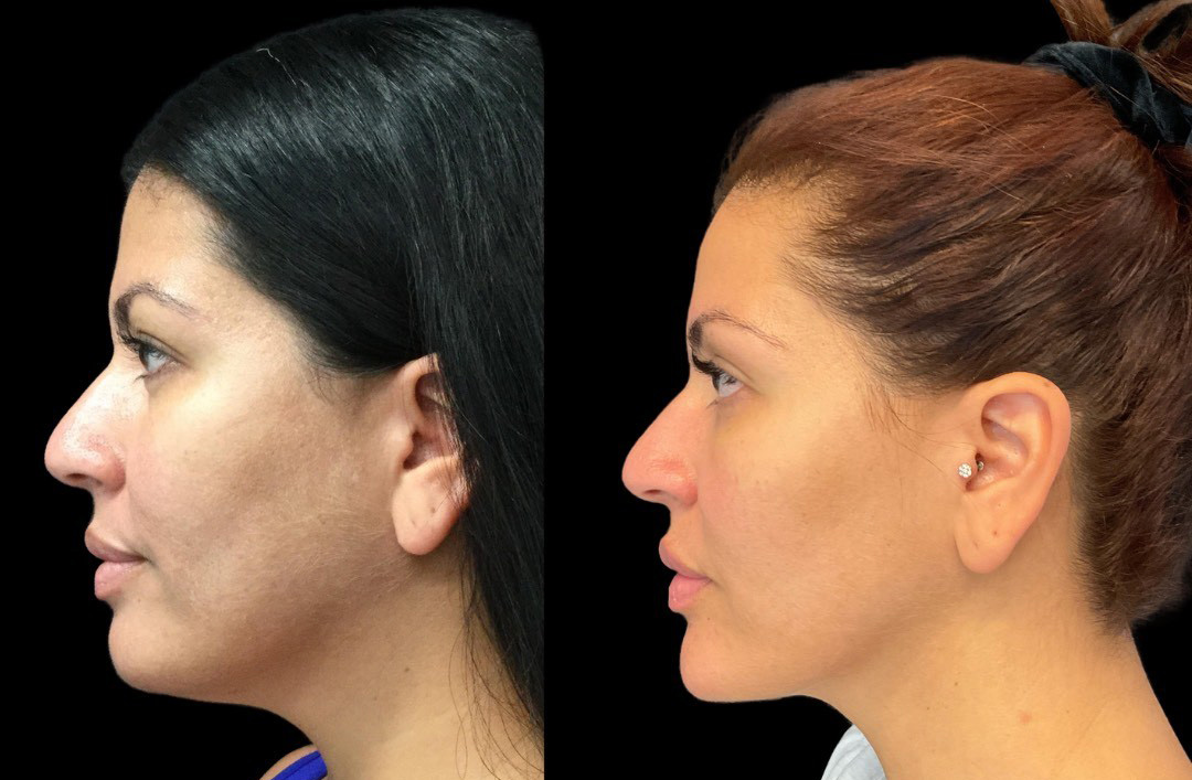 thumbnail_Fillerskincare_female_beforeafter-3.jpg