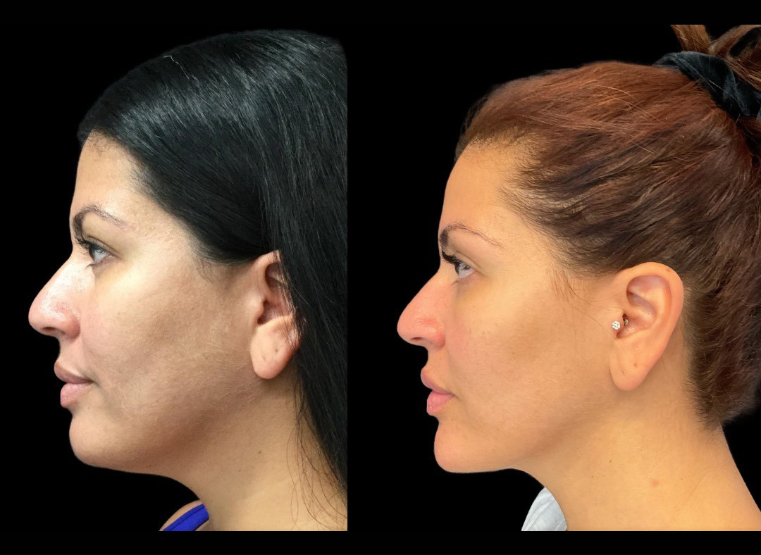 thumbnail_Fillerskincare_female_beforeafter-3.jpg