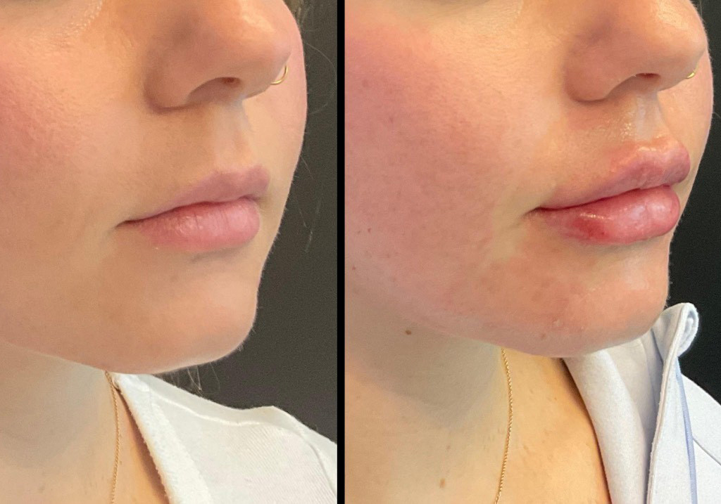 thumbnail_Injectables_female_Before_and_After-1.jpg