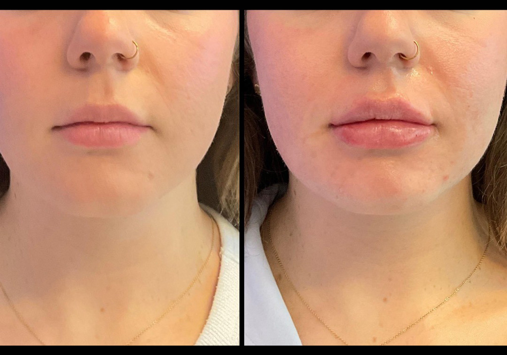 thumbnail_Injectables_female_Before_and_After-2.jpg